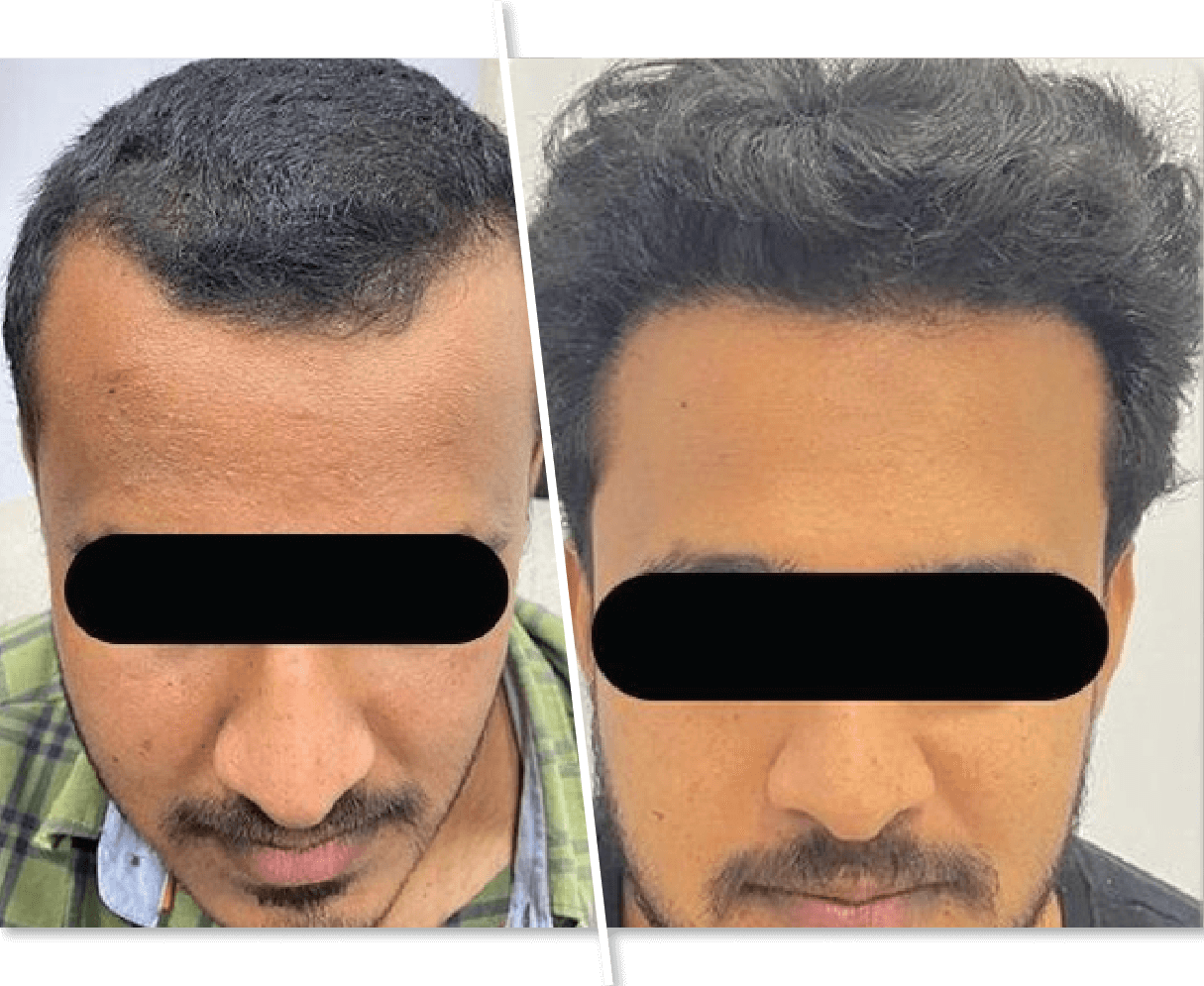 Young Man Before and After Hair Treatment